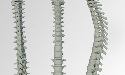 lumbar disk spinal chord