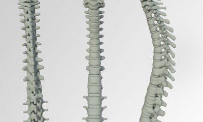 lumbar disk spinal chord